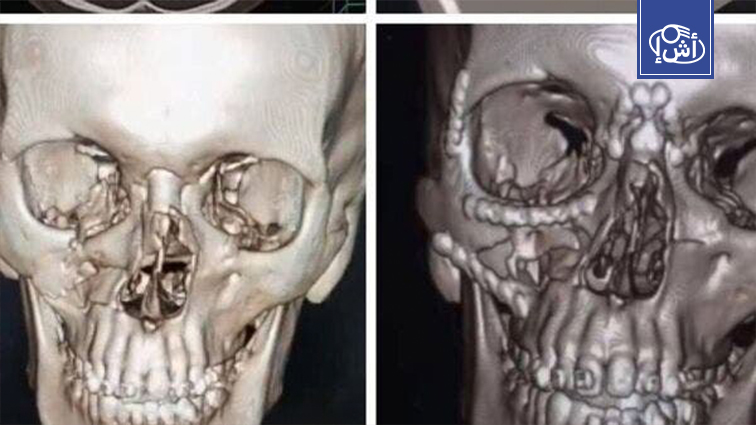 فريق طبي بمصر ينجح في أول عملية لإعادة بناء عظام وجه شاب