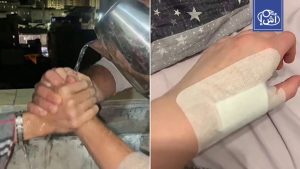 تحذيرات عاجلة في مصر من تحدي “الماء المغلي” الخطير على وسائل التواصل